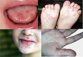 Pessoas morrem com vírus altamente contagioso no Brasil